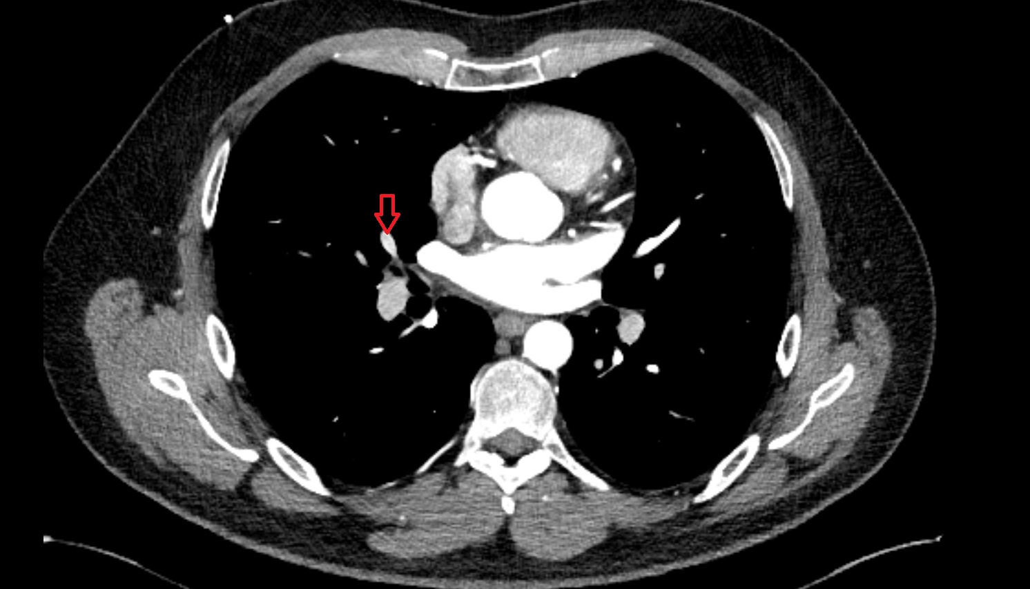 Middle lobar artery of right lung  anatomy CT axial  image -img-00000-00000_00001