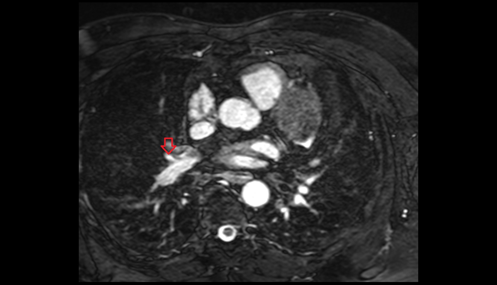 Middle lobar artery of right lung mri image