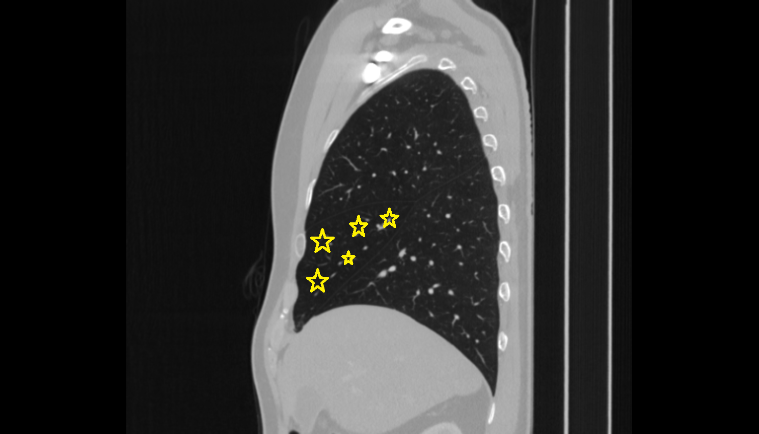 Middle lobe of right lung CT Anatomy, Location and Imaging Appearance CT anatomy image -img-00000-00000