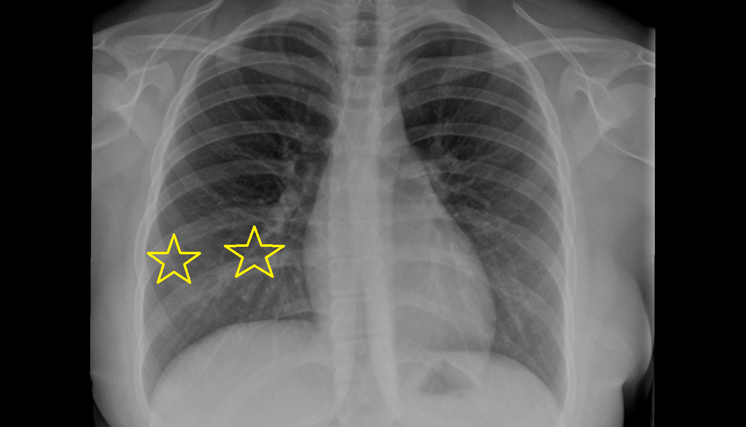 Middle lobe of right lung X RAY anatomy image -img-00000-00000