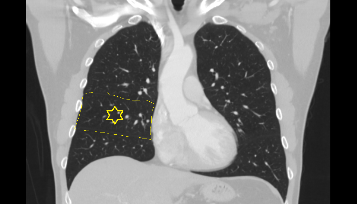 Middle lobe of right lung of right lung CT anatomy image -img-00000-00000