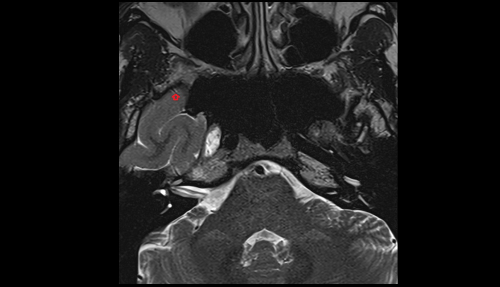 Middle meningeal artery