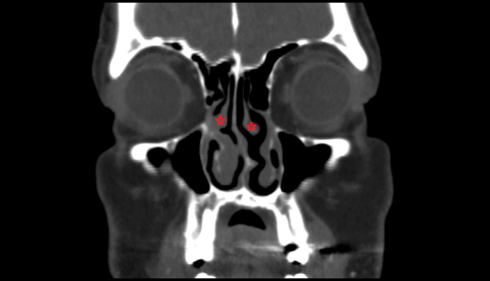 CT Middle nasal concha