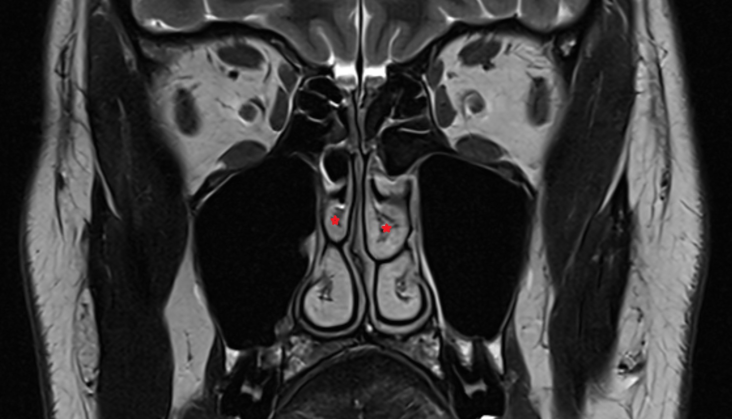 Middle nasal concha  mri axial  image -img-00000-00000