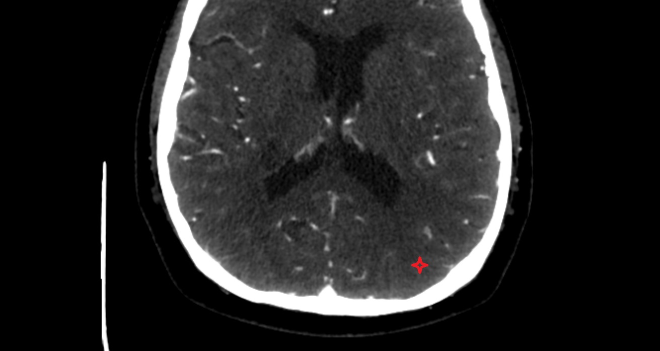 Middle occipital gyrus  CT axial anatomy image -img-00001-00001