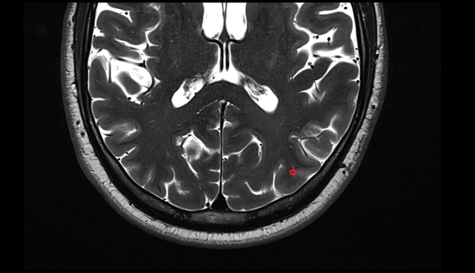 Middle occipital gyrus mri 3t axial image