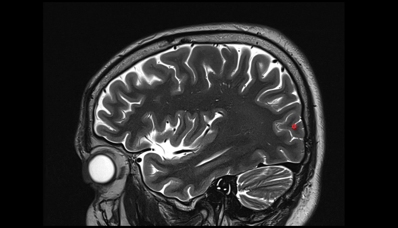 Middle occipital gyrus mri 3t sagittal image