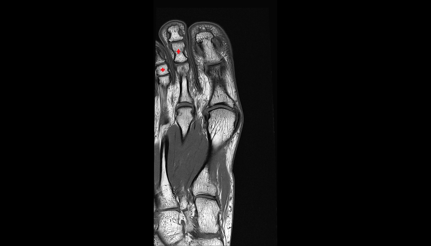 Middle phalanx foot coronal cross sectional anatomy 3T MRI AI enhanced radiology image-img-00000-00000_00001