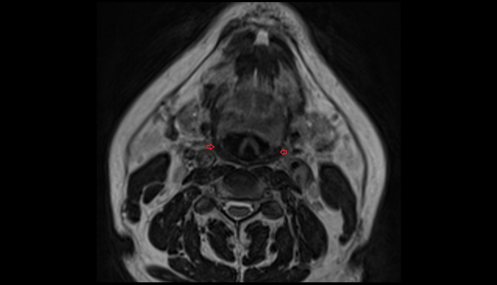 Middle pharyngeal constrictor muscle