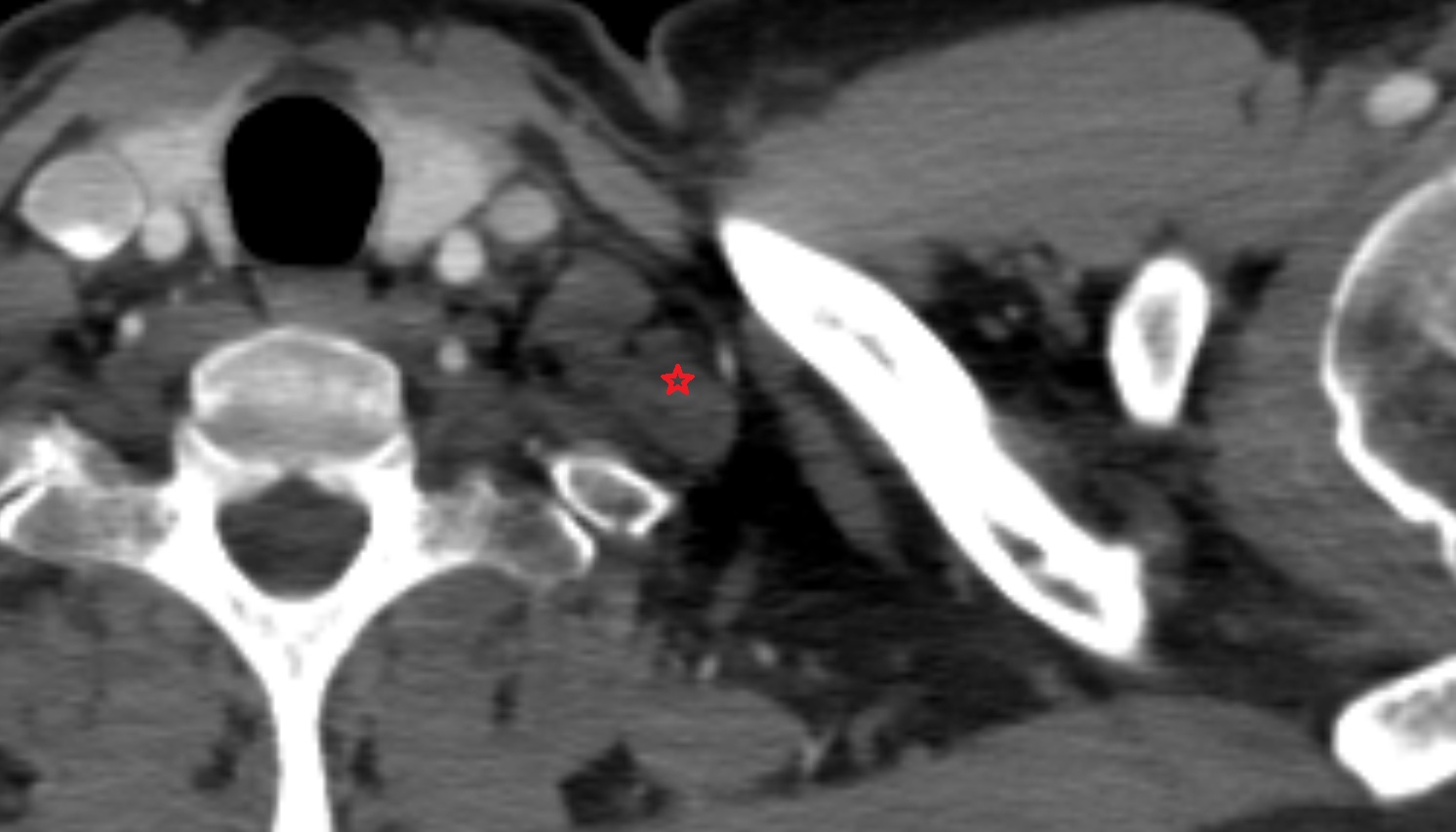 Middle scalene muscle  anatomy CT axial  image -img-00000-00000