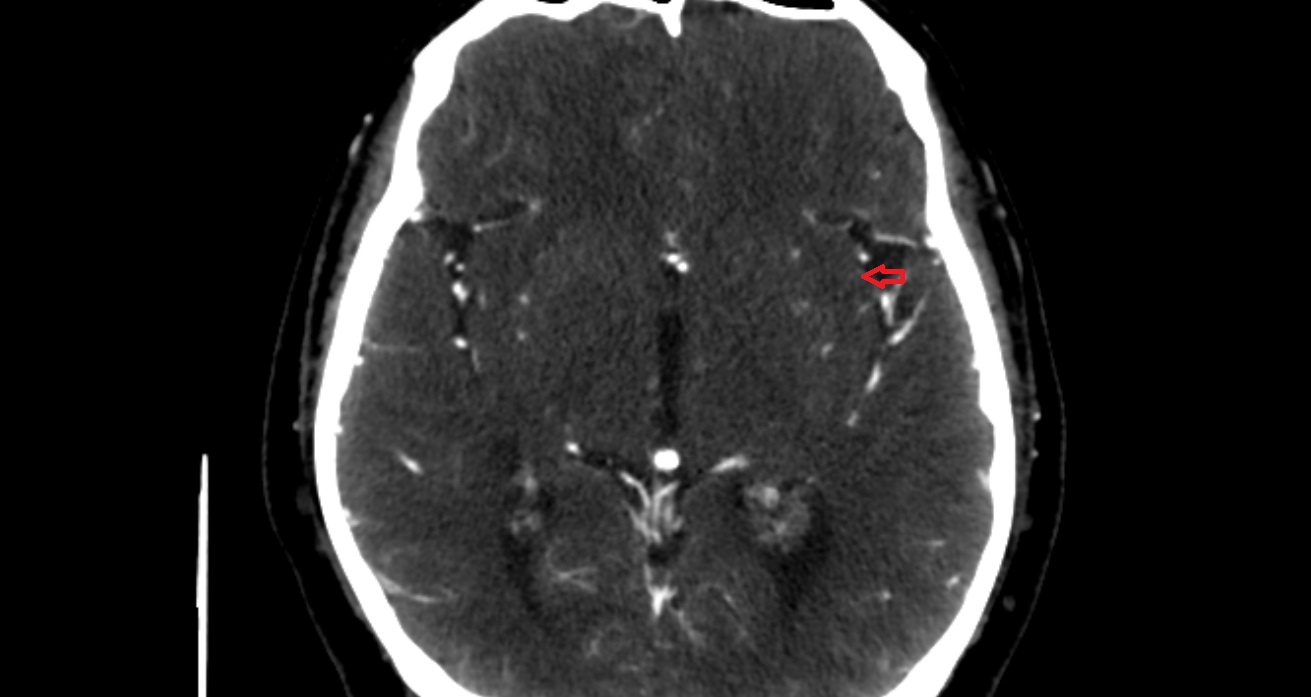 Middle short insular gyrus  CT axial anatomy image -img-00001-00001