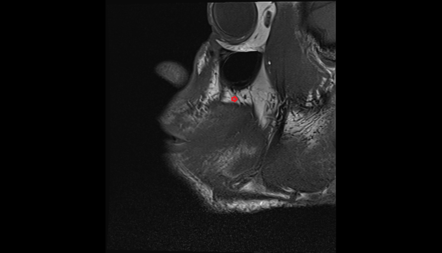 Middle superior alveolar nerve  mri sagittal  image -img-00000-00000