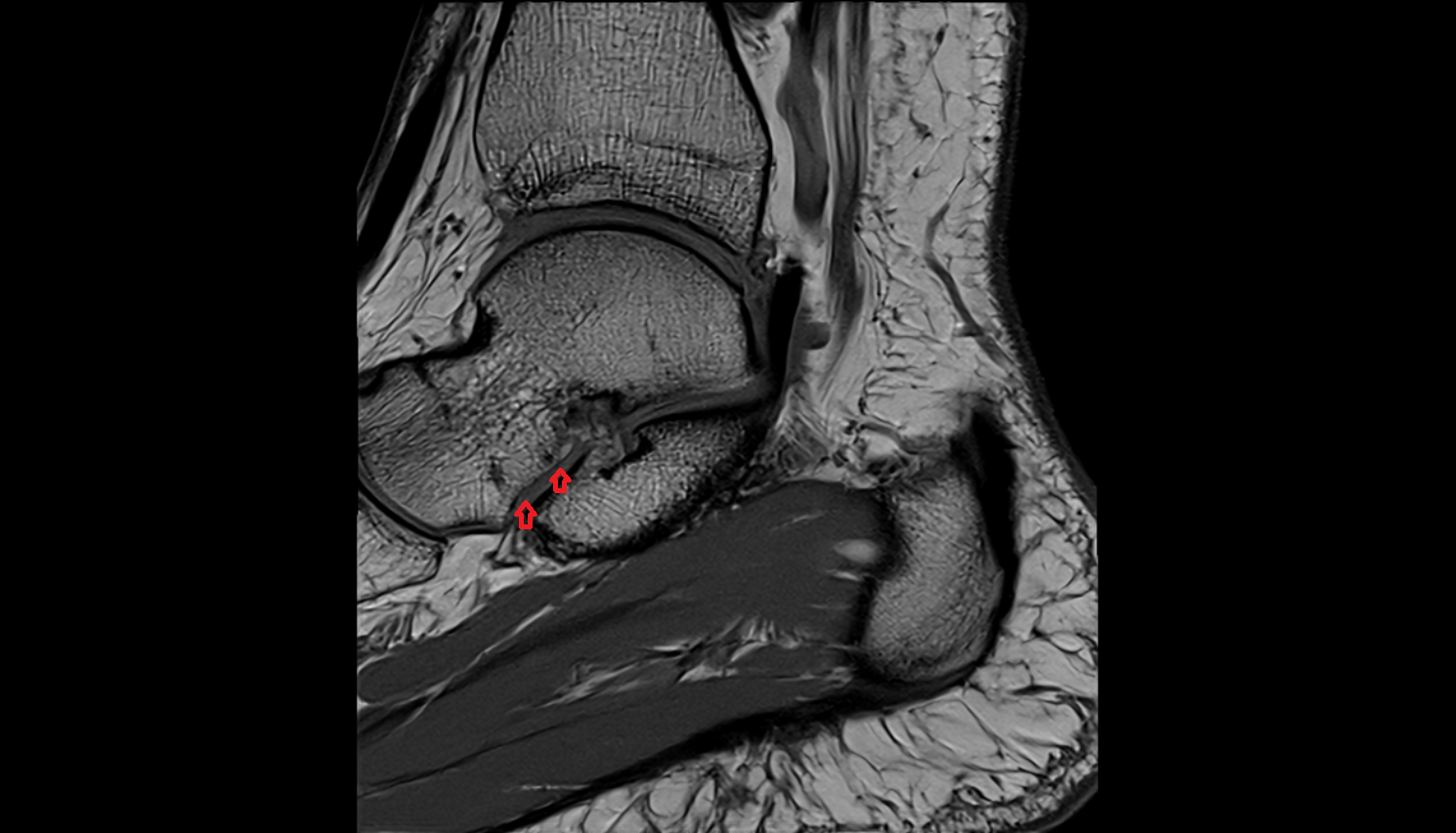 Middle talar articular surface  mri  anatomy labelled image-img-00000-00000