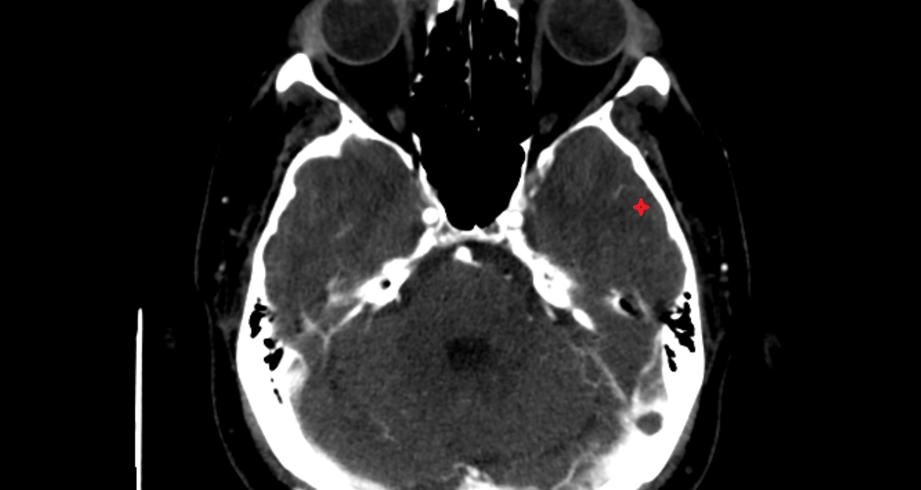 Middle temporal gyrus  CT axial anatomy image -img-00001-00001
