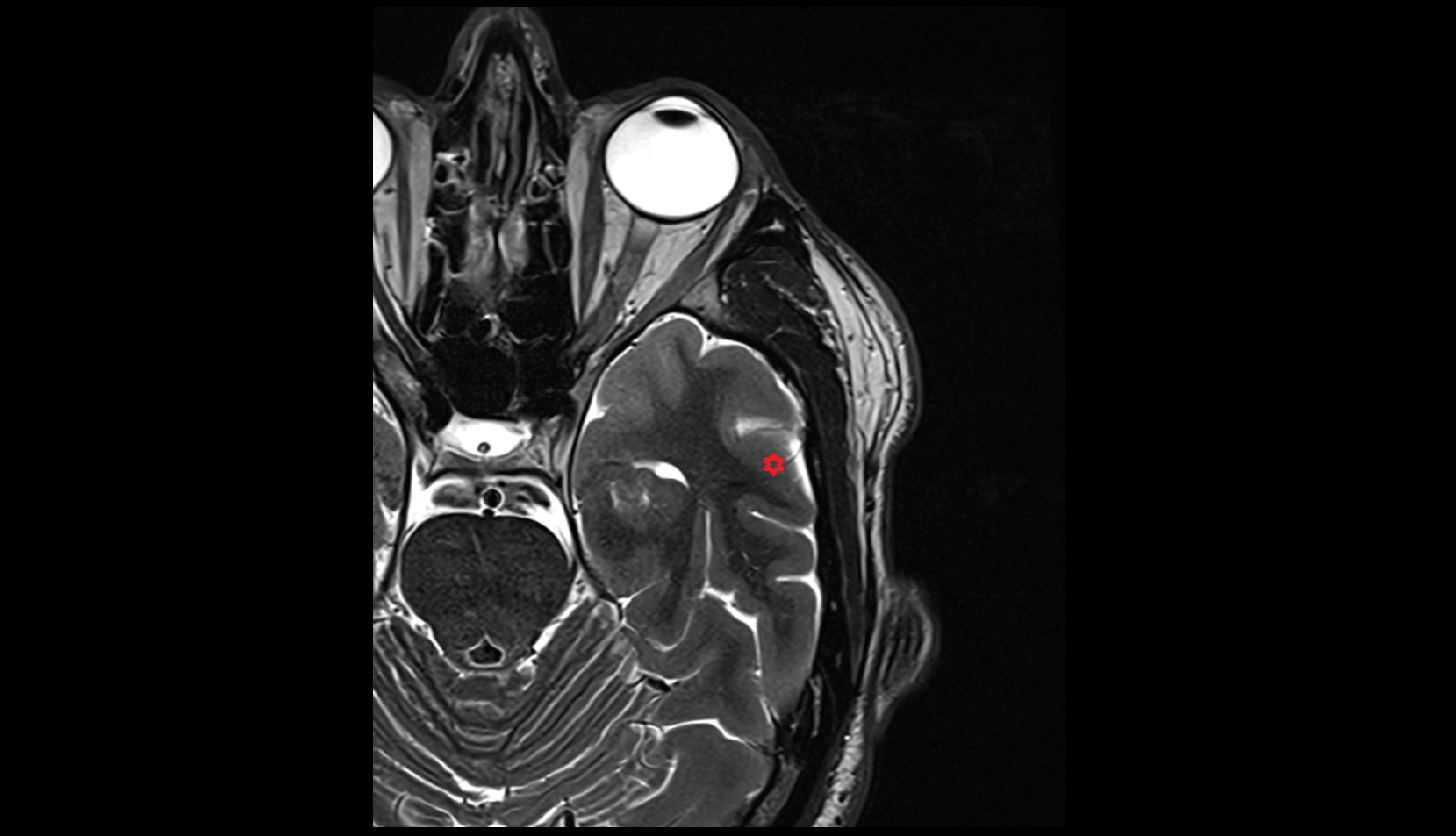 Middle temporal gyrus MRI 3T axial image