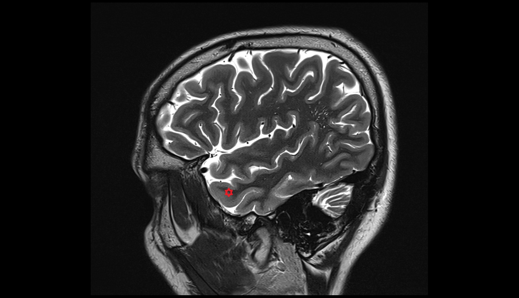 Middle temporal gyrus MRI 3T sagittal image