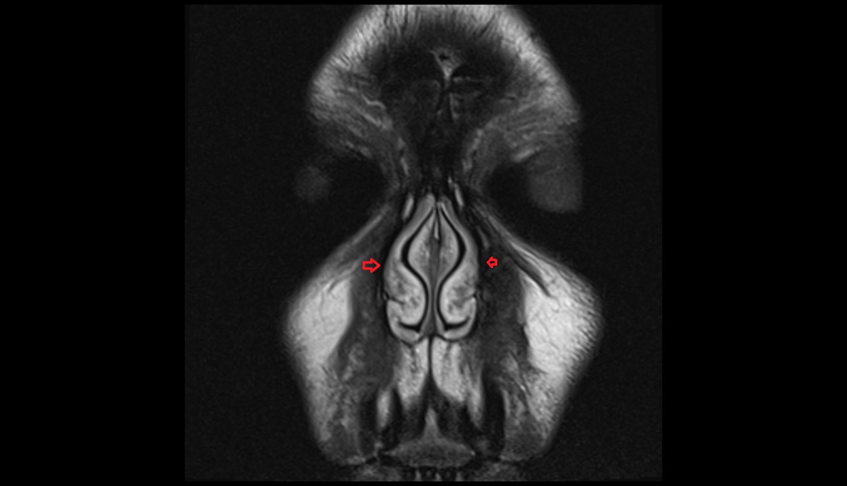 Minor alar cartilage coronal mri