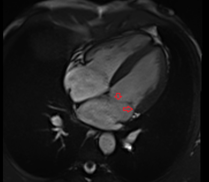 Mitral valve, Left atrioventricular valve, Bicuspid valve - Copy