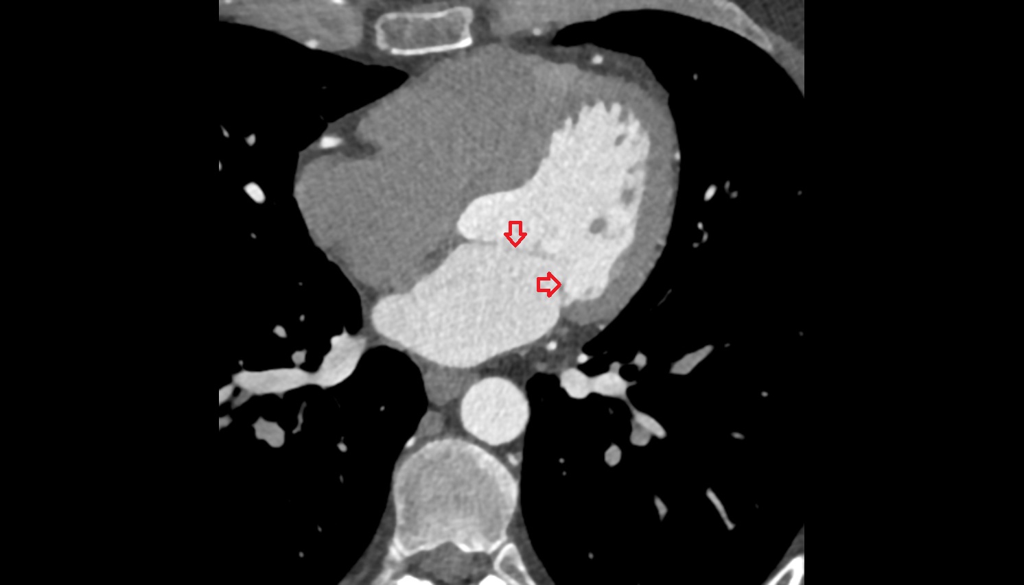 Mitral valve, Left atrioventricular valve, Bicuspid valve  ct AXIAL  image -img-00000-00000