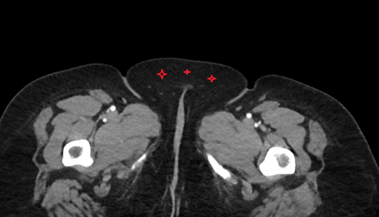 Mons pubis   CT axial  anatomy  image-img-00000-00000