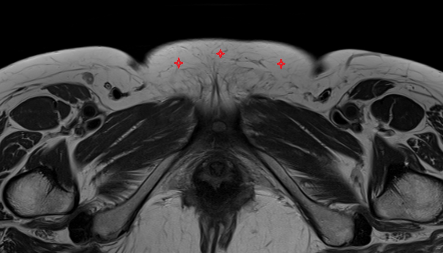 Mons pubis   MRI axial  anatomy  image-img-00000-00000