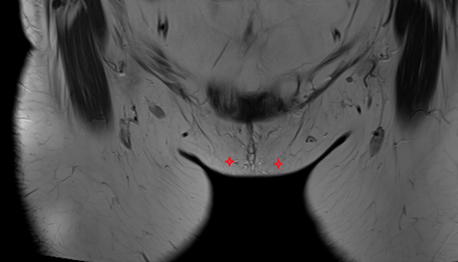 Mons pubis   MRI coronal  anatomy  image-img-00000-00000