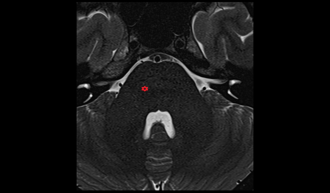 Motor nucleus of trigeminal nerve mri 3t image
