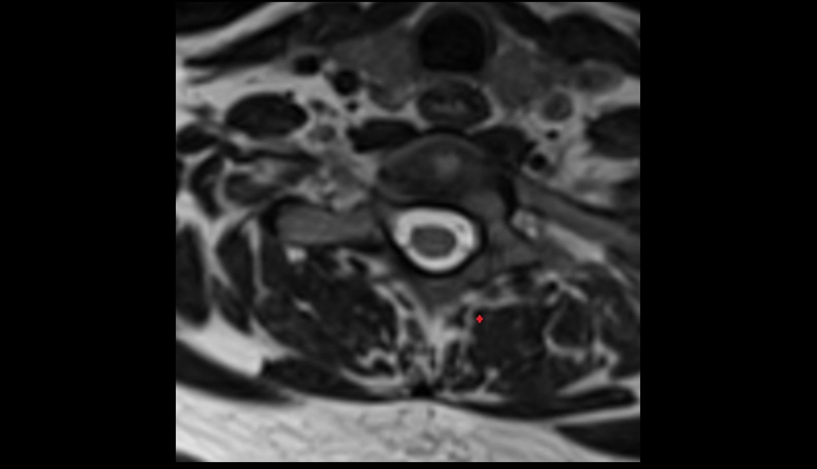 Multifidus Muscle mri axial image
