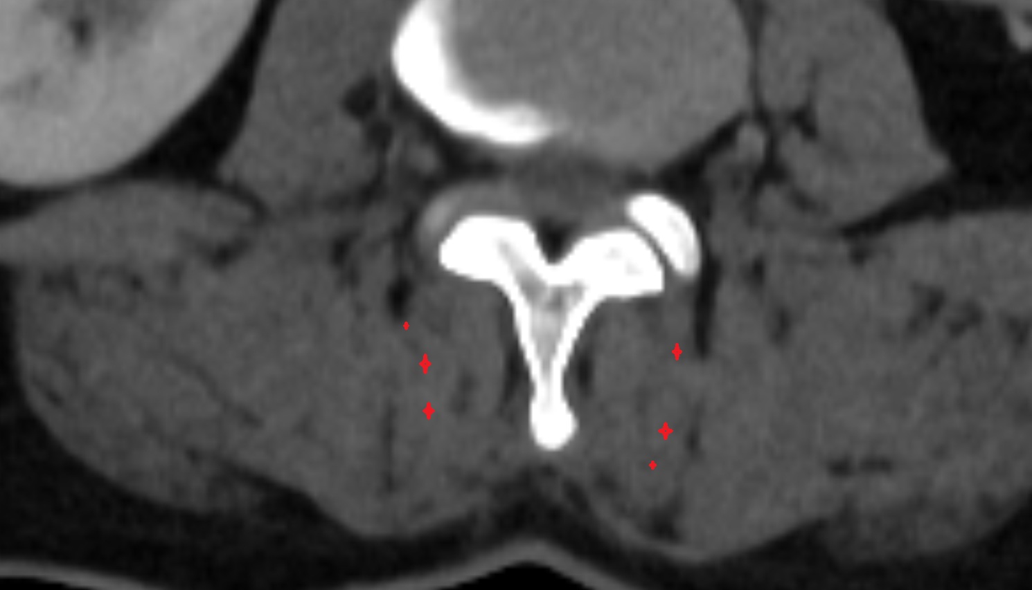 Multifidus muscle  CT axial  anatomy  image-img-00000-00000