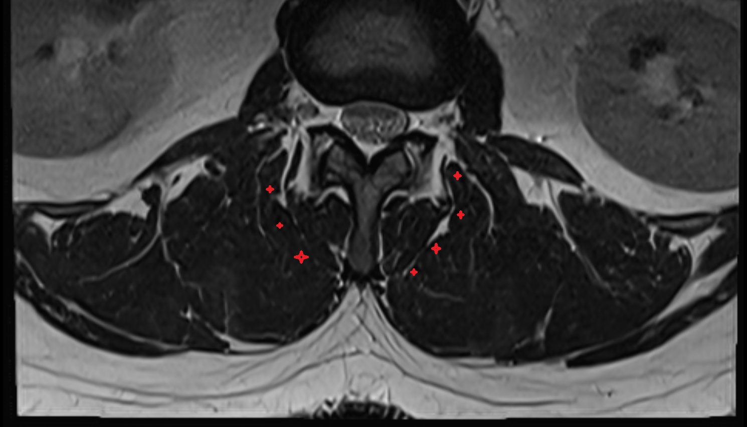 Multifidus muscle  MRI axial  anatomy  image-img-00000-00000
