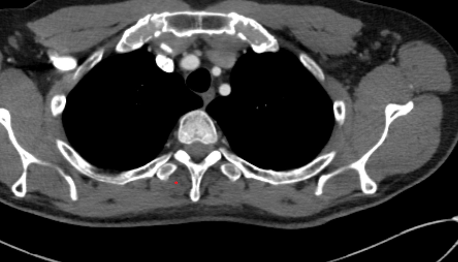 Multifidus muscle  anatomy ct axial  image -img-00000-00000