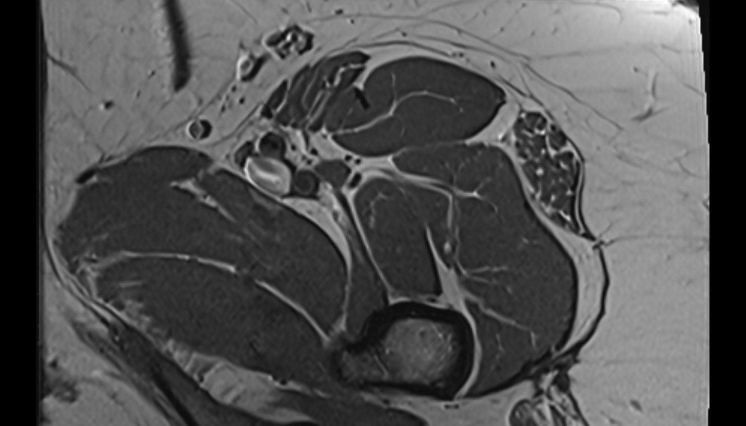 Muscular branches of femoral nerve MRI  axial  anatomy  image-img-00000-00000