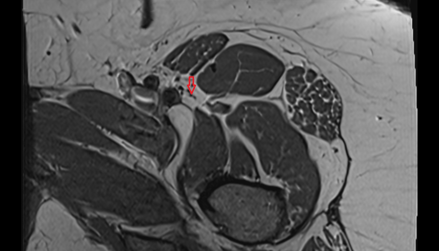 Muscular branches of femoral nerve MRI  axial  anatomy  image-img-00000-00000_00001