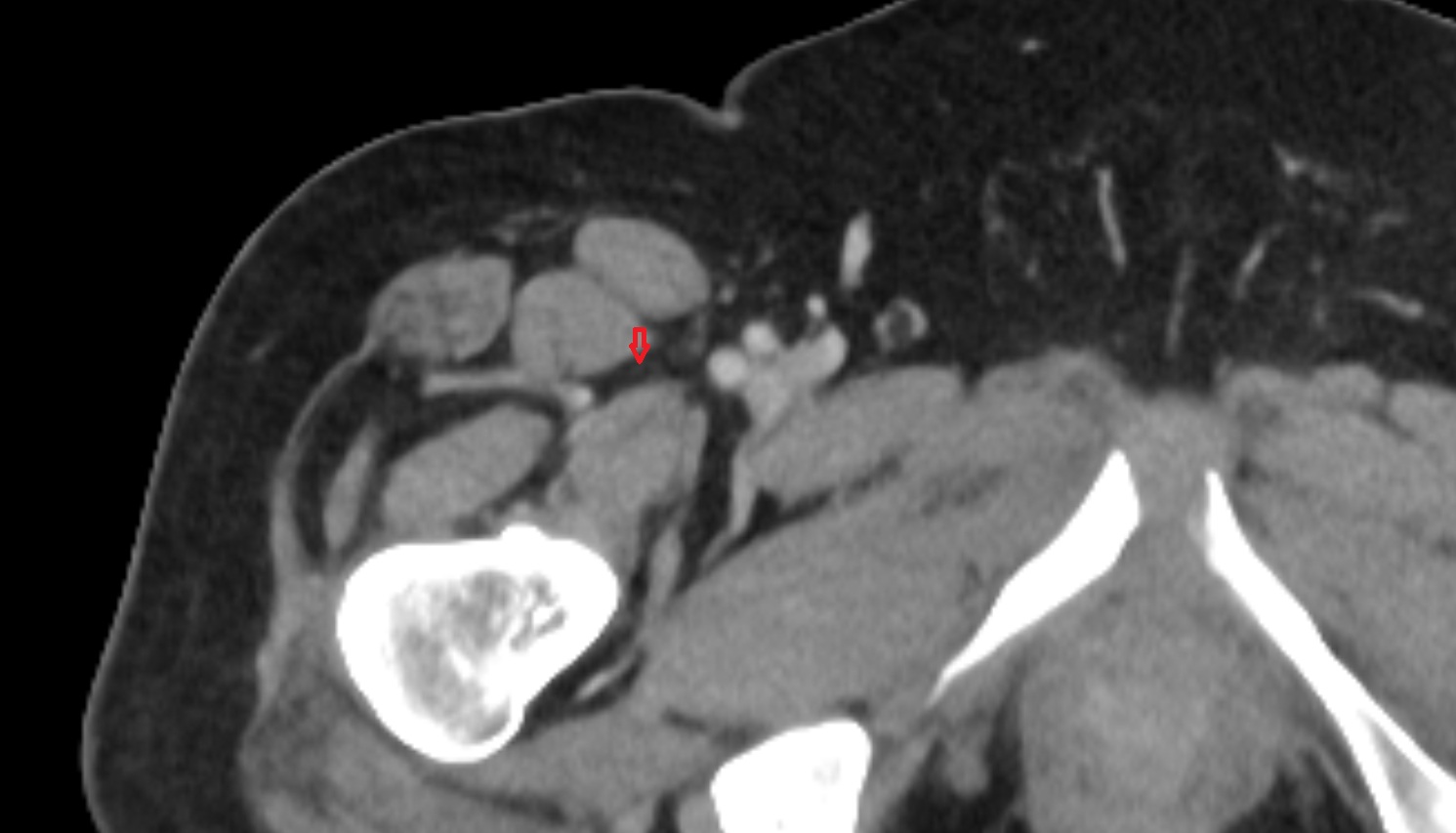 Muscular branches of femoral nerve  ct  axial  anatomy  image-img-00000-00000