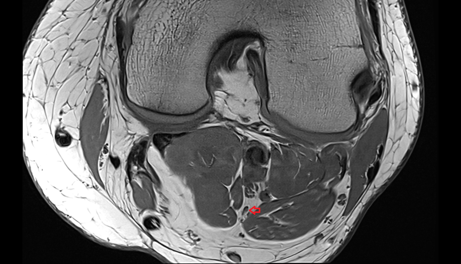 Muscular branches of tibial nerve axial  cross sectional anatomy 3T MRI AI enhanced  radiology  anatomy image-img-00000-00000