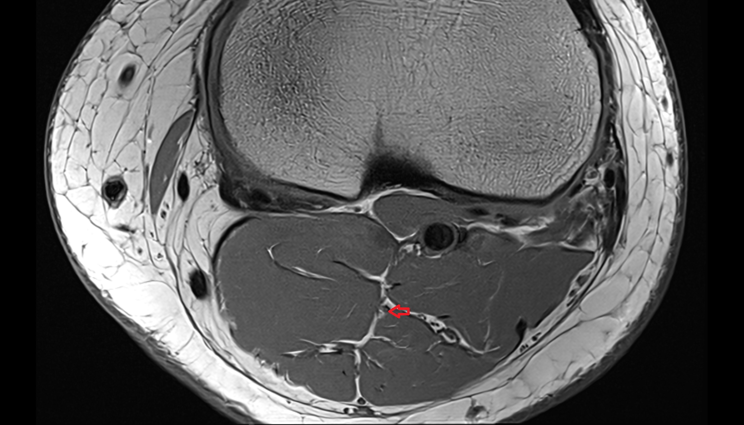 Muscular branches of tibial nerve axial  cross sectional anatomy 3T MRI AI enhanced  radiology  anatomy image-img-00000-00000_00001