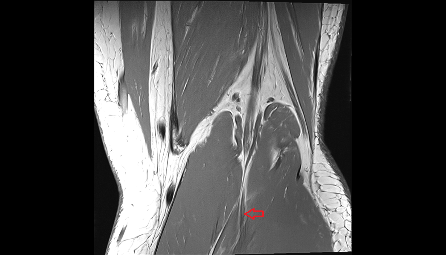 Muscular branches of tibial nerve coronal  cross sectional anatomy 3T MRI AI enhanced  radiology  anatomy image-img-00000-00000