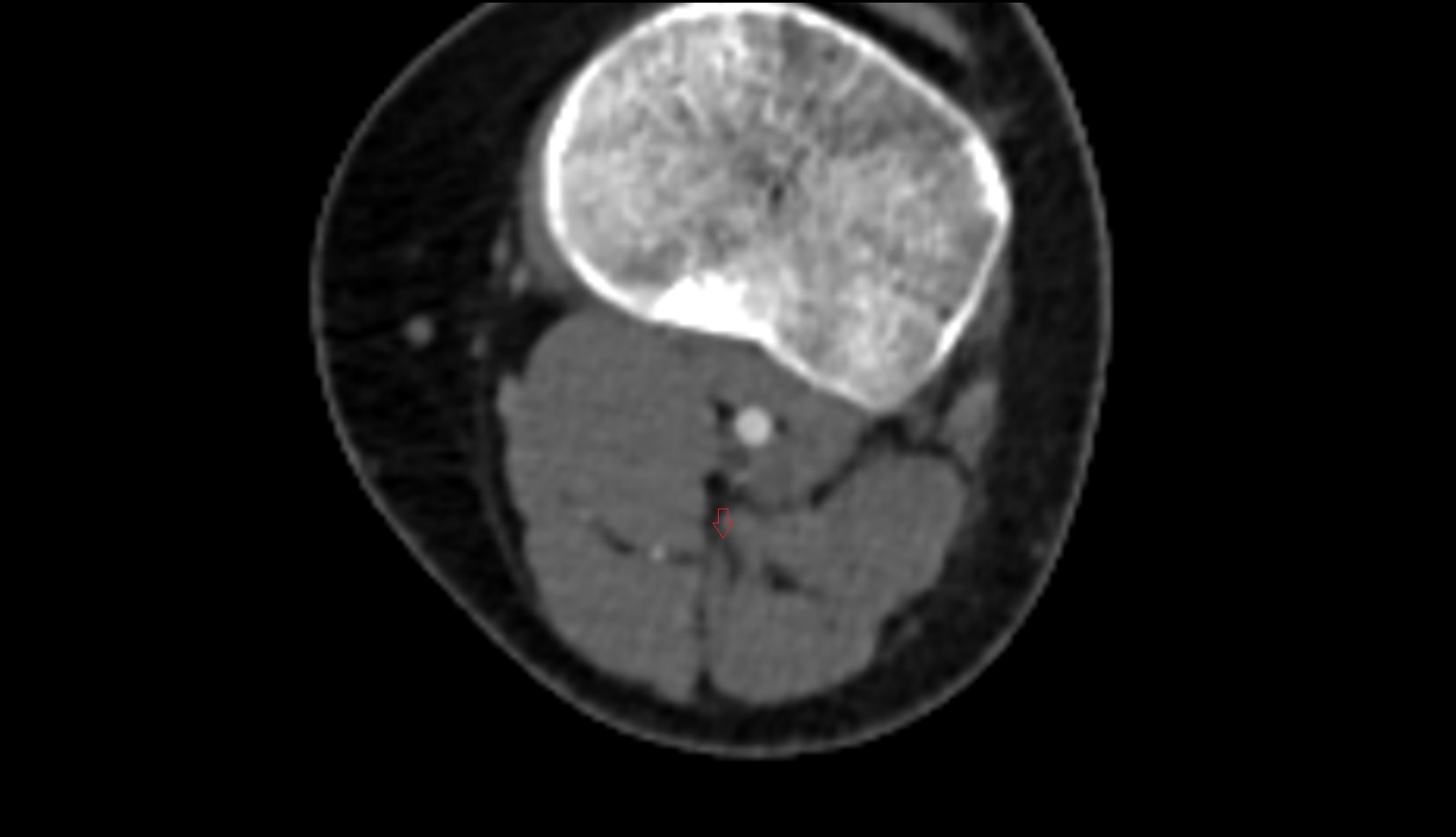 Muscular branches of tibial nerve ct axial