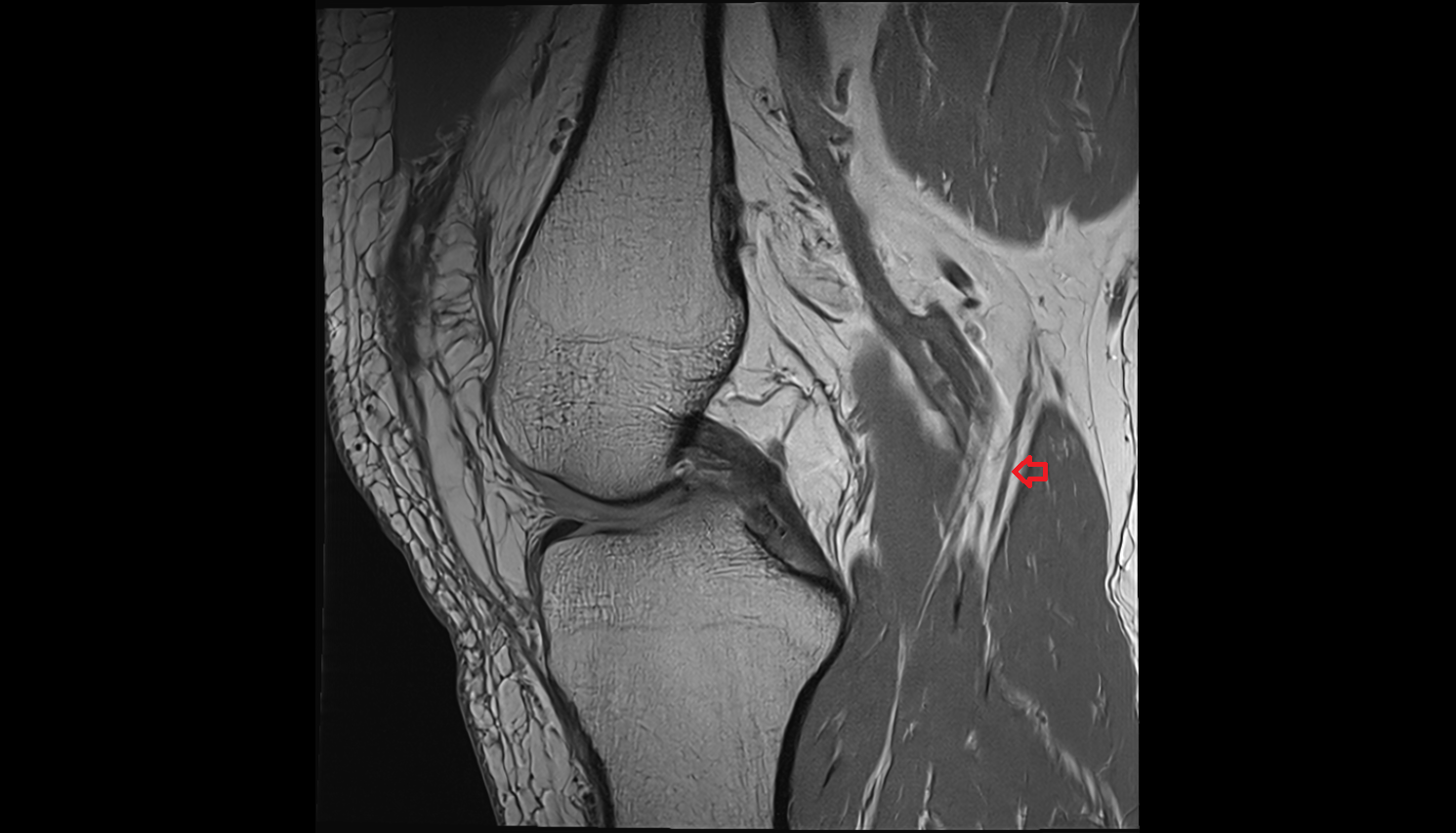 Muscular branches of tibial nerve sagl  cross sectional anatomy 3T MRI AI enhanced  radiology  anatomy image-img-00000-00000