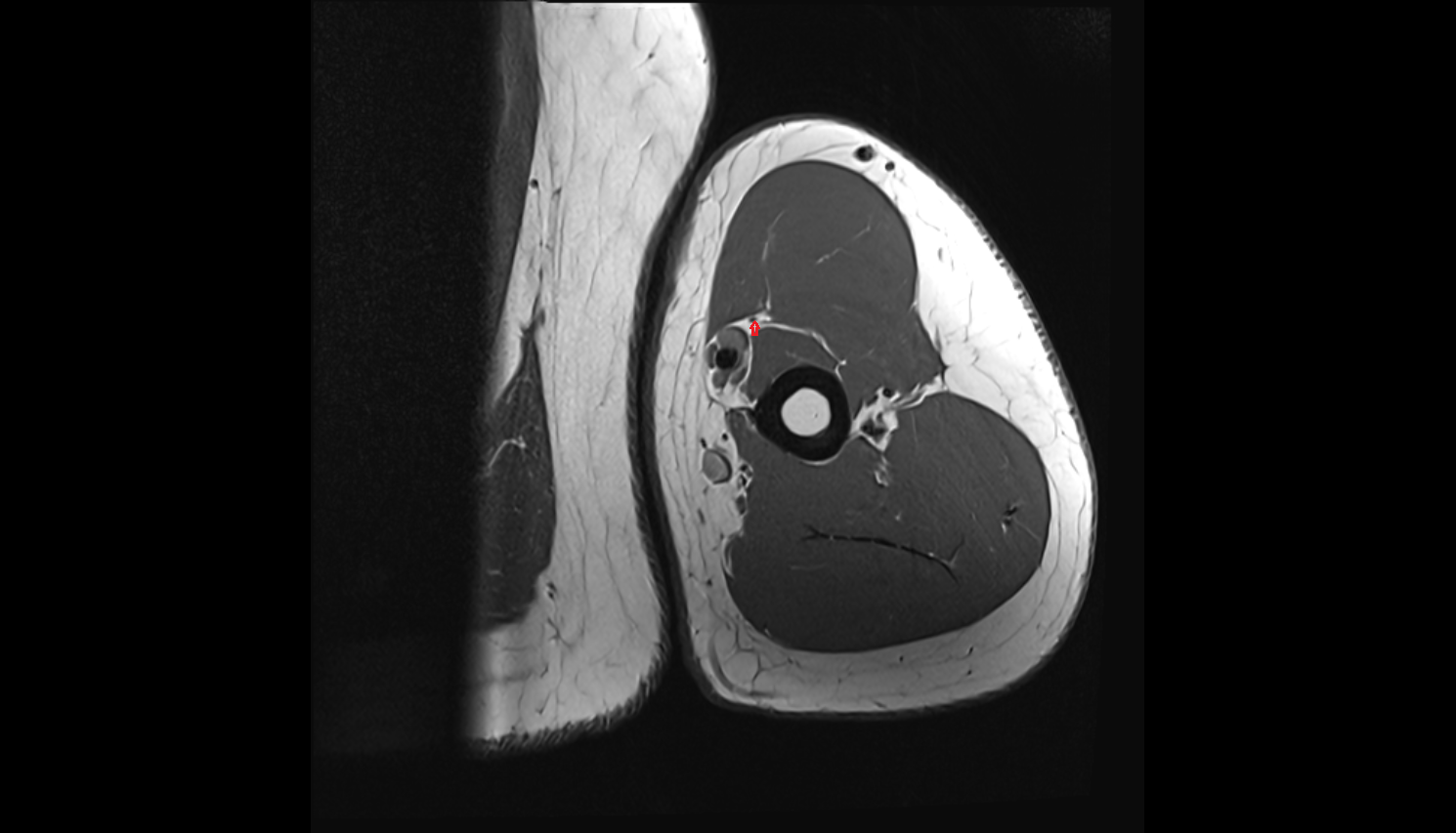 Musculocutaneous nerve  axial cross sectional anatomy 3T MRI AI enhanced radiology image -img-00000-00000