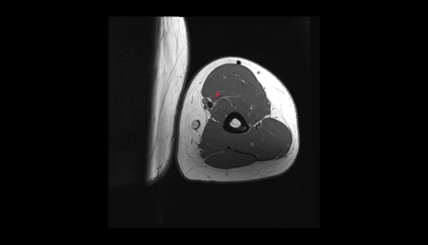 Musculocutaneous nerve  axial cross sectional anatomy 3T MRI AI enhanced radiology image -img-00000-00000_00001