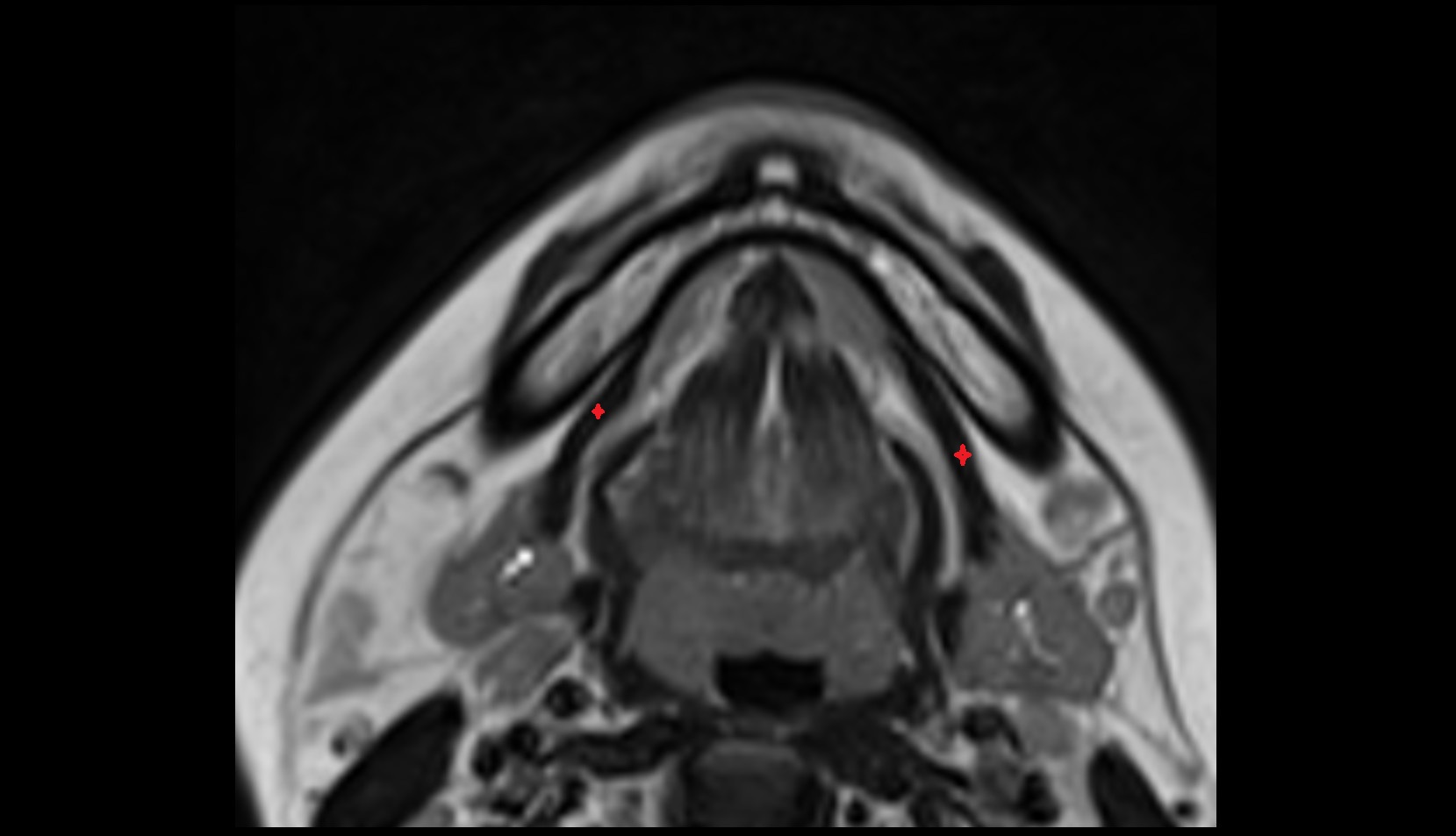 Mylohyoid muscle mri axial image