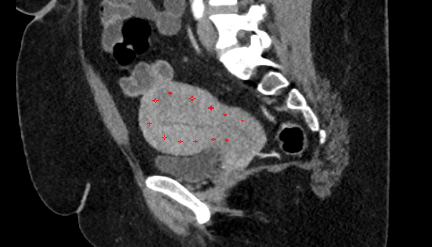 Myometrium of uterus CT  sagittal  image anatomy  image-img-00000-00000