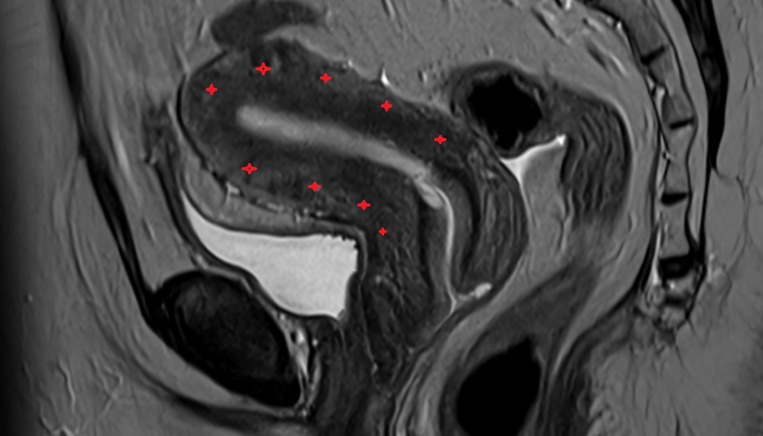 Myometrium of uterus  MRI  sagittal  image anatomy  image-img-00000-00000