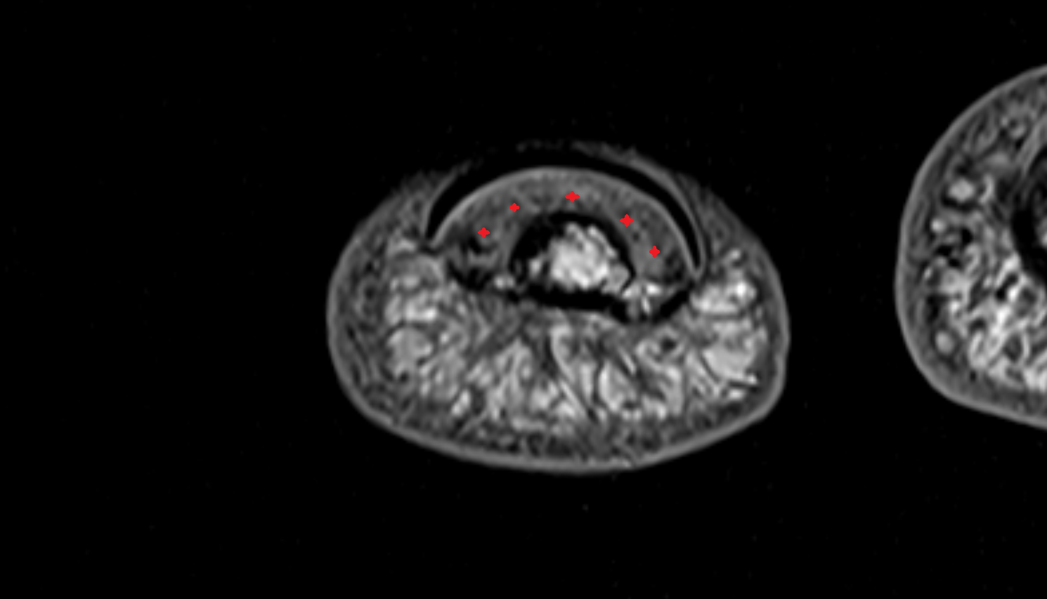 Nail bed corion hand  MRI axial  image-img-00000-00000