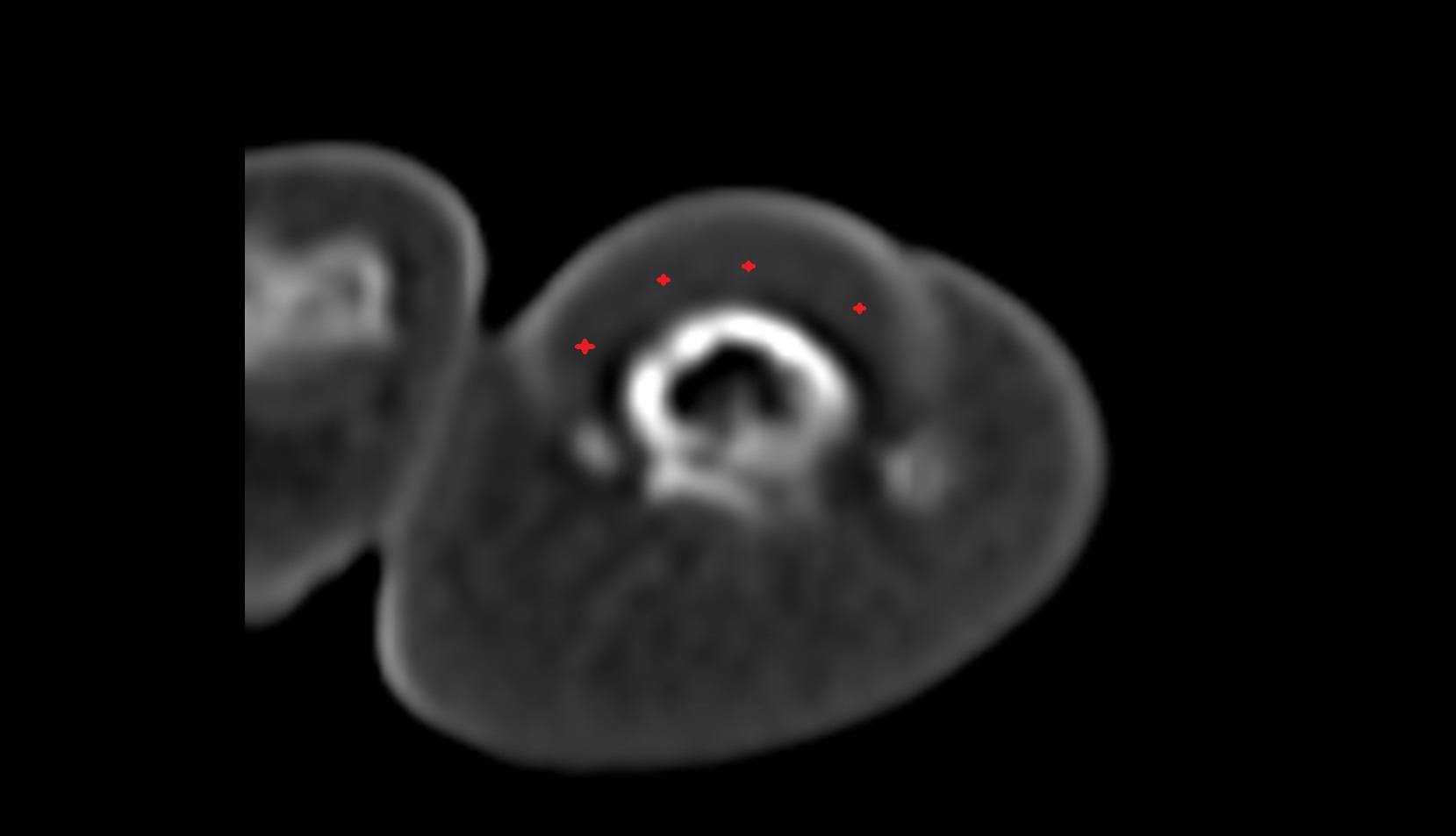 Nail bed ct axial image