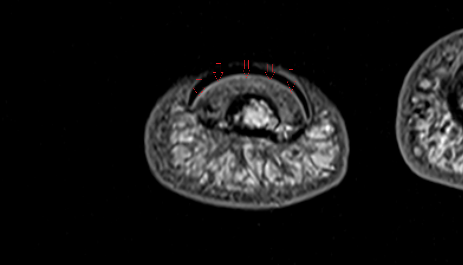 Nail bed hand  MRI axial  image-img-00000-00000