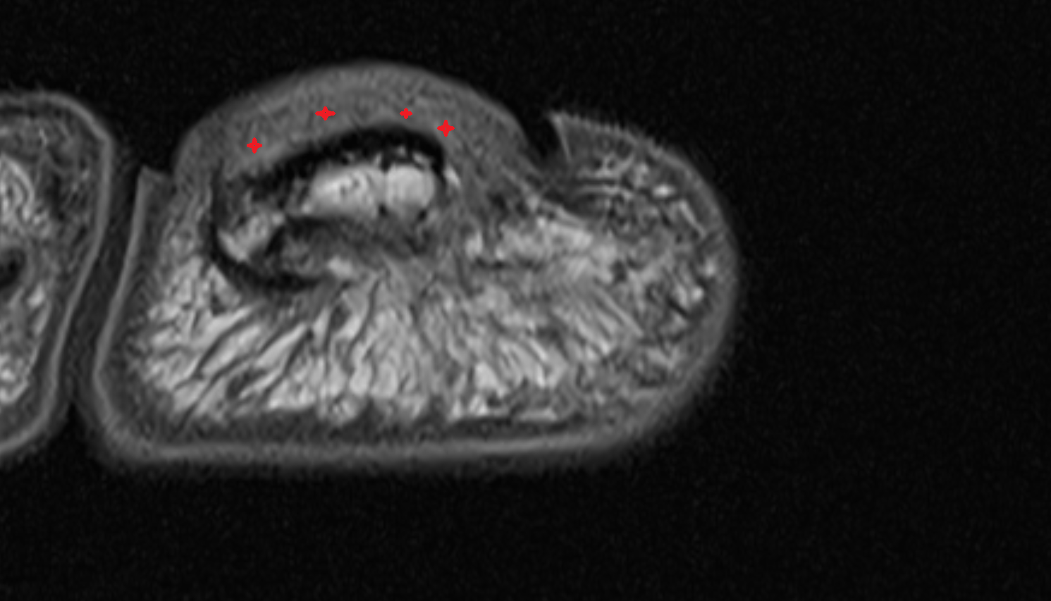 Nail bed of toe axial cross sectional anatomy 3T MRI AI enhanced radiology image-img-00000-00000