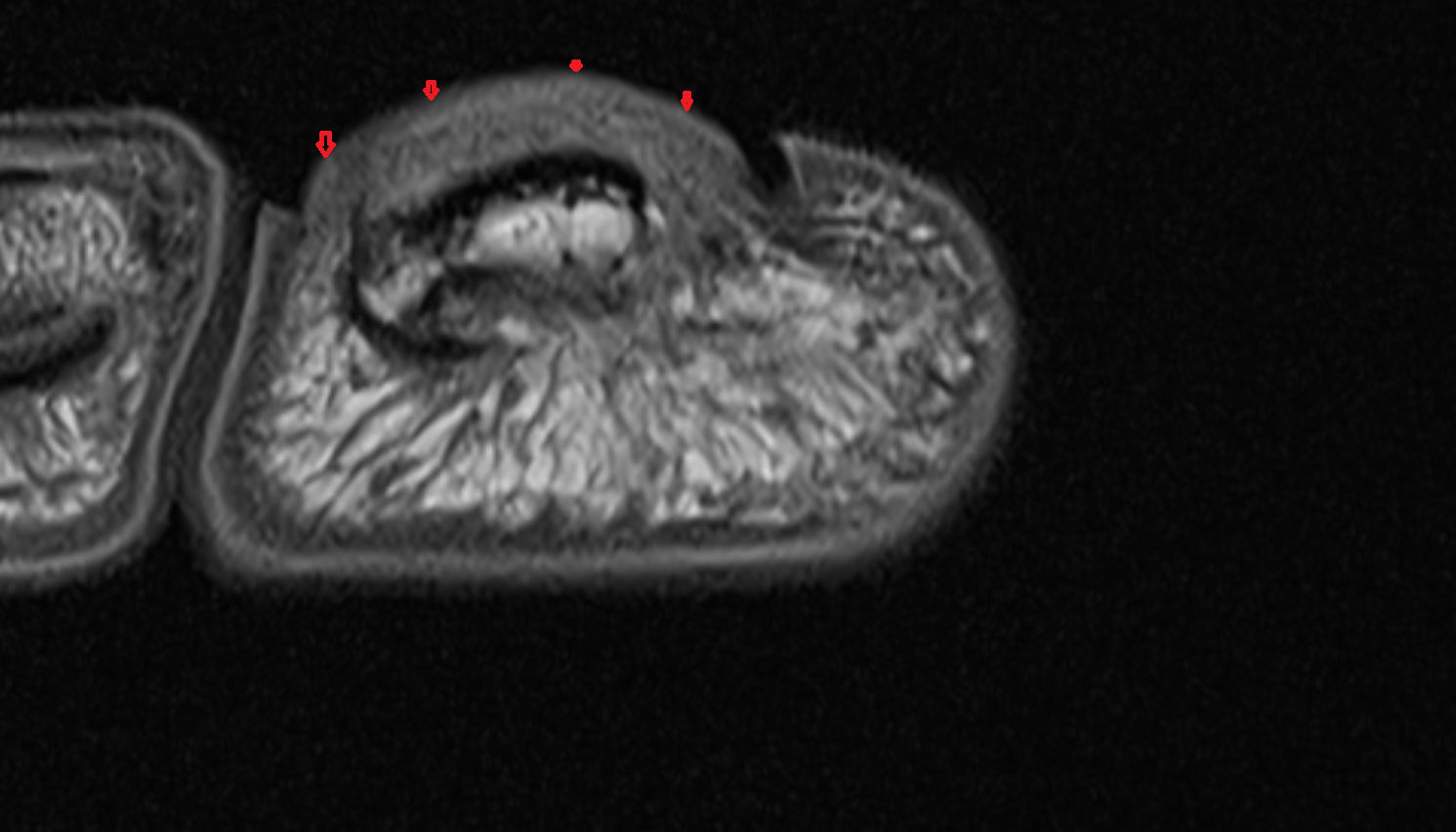 Nail of toe axial cross sectional anatomy 3T MRI AI enhanced radiology image-img-00000-00000