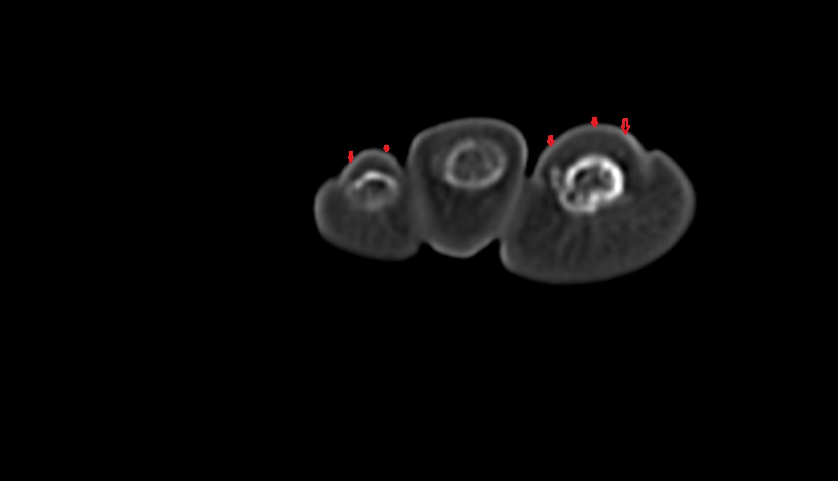 Nail of toe ct axial image
